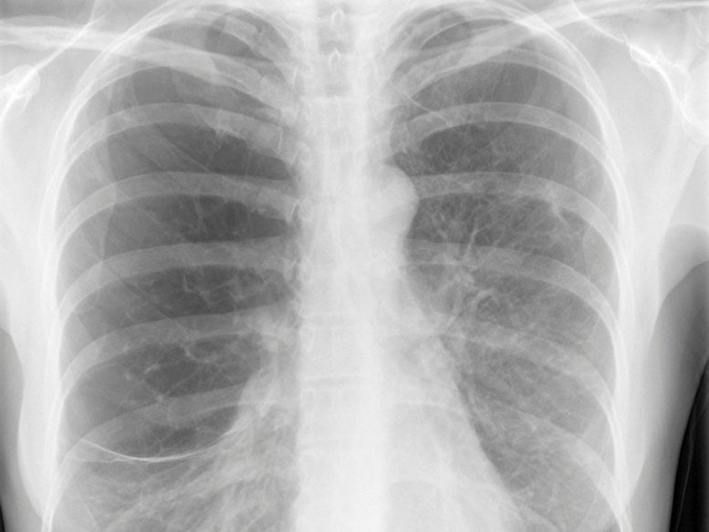 Chest X-Ray Smoker Lungs Emphysema