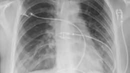 Chest X-ray Vaping Lung Injury