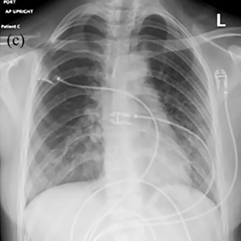 Chest X-ray Vaping Lung Injury