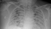 Chest X-ray of COVID-19 Patient
