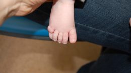 Child With Extra Toe