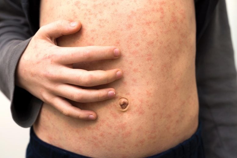 Child With Measles Rash