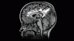 Child's Altered Brain Connectivity