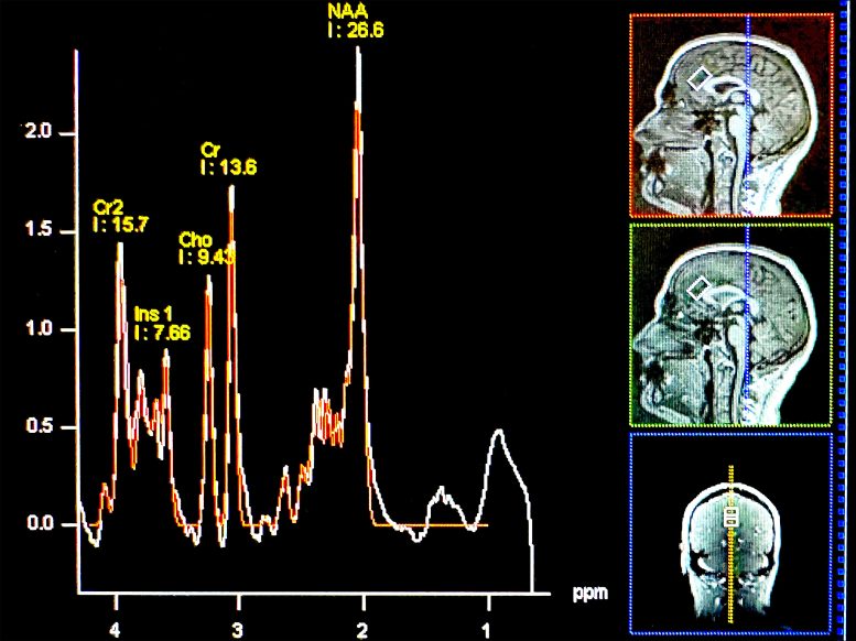 Choline Levels in the Brain