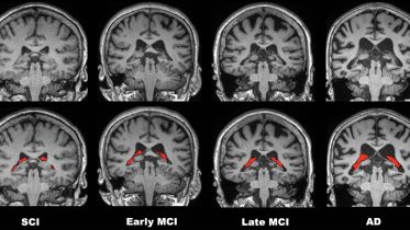 Volume of Choroid Plexus in Brain Linked to Alzheimer’s Disease