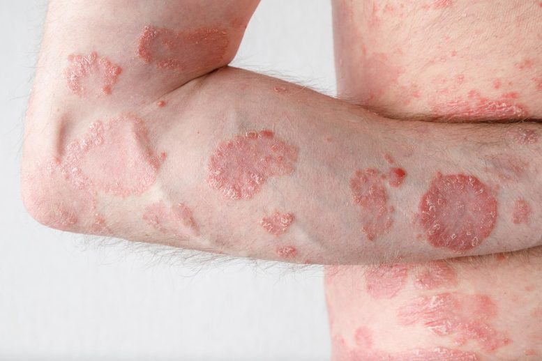Chronic Psoriasis Skin Inflammation