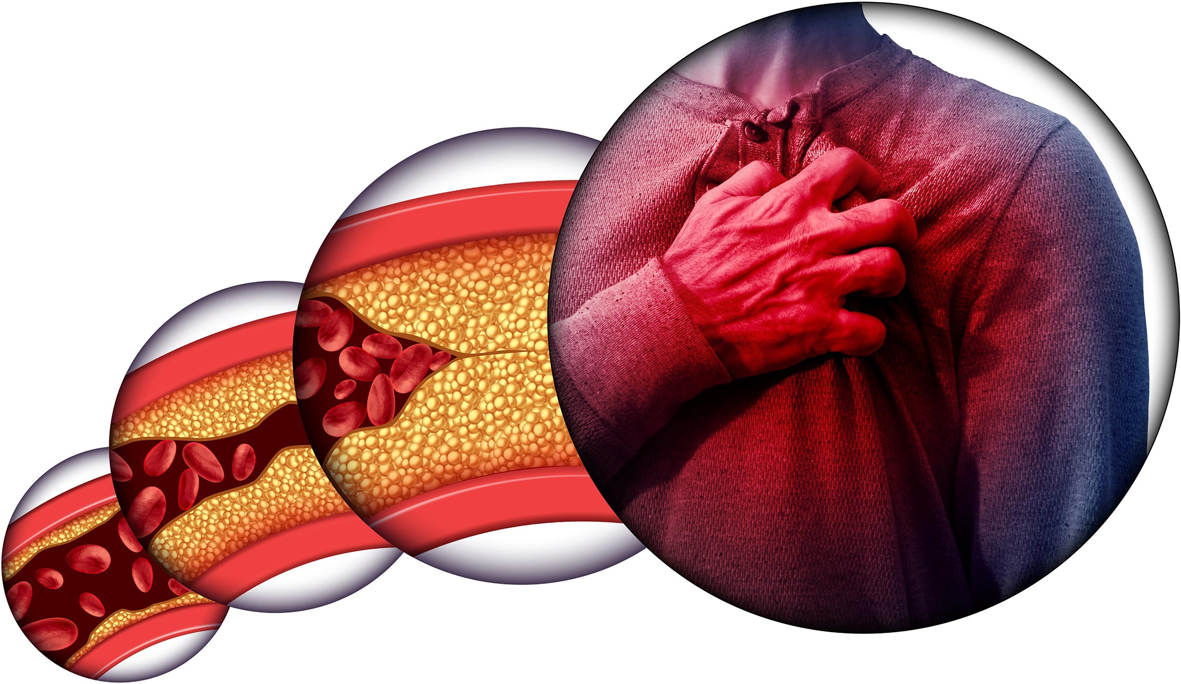 Heart Disease: “Good” Cholesterol May Not Be Good for Everyone – SciTechDaily