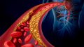 Clogged Artery Atherosclerosis Disease