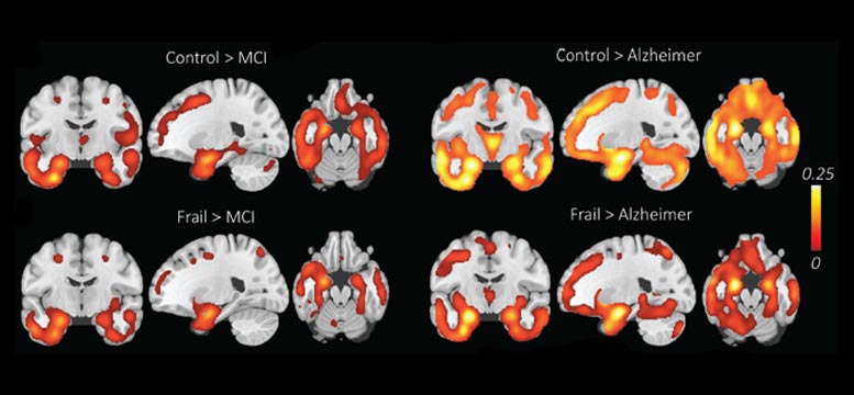 Cognitive Decline Not Alzheimer’s Disease