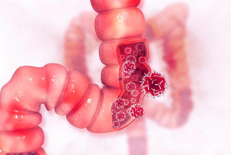 Investigadores descubren cómo la aspirina inhibe el cáncer de intestino