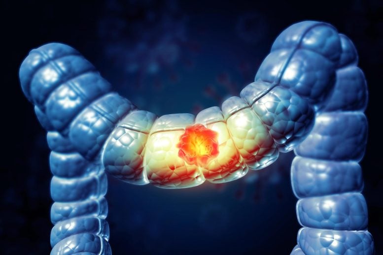 Colon Cancer Large Intestine