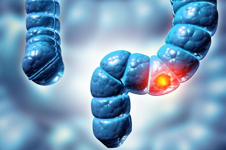 Scientists Discover Hidden Virus Linked to Colorectal Cancer