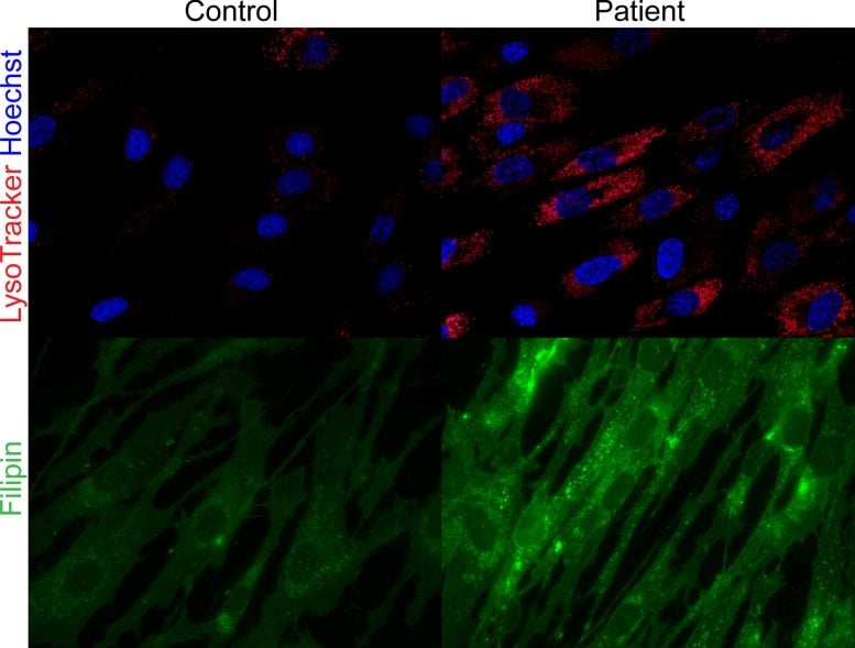 Control and Patient Fibroblast Cells With Staining