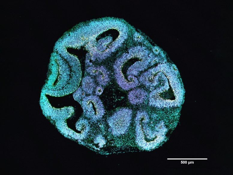 One Small Mutation Can Disrupt Brain Growth for Life