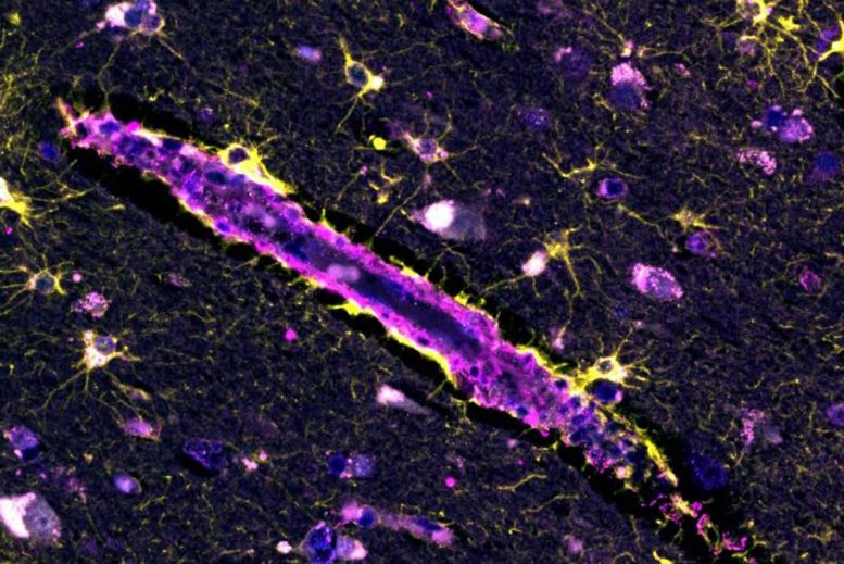 Rare Mutation May Shield the Brain From Alzheimer’s Damage