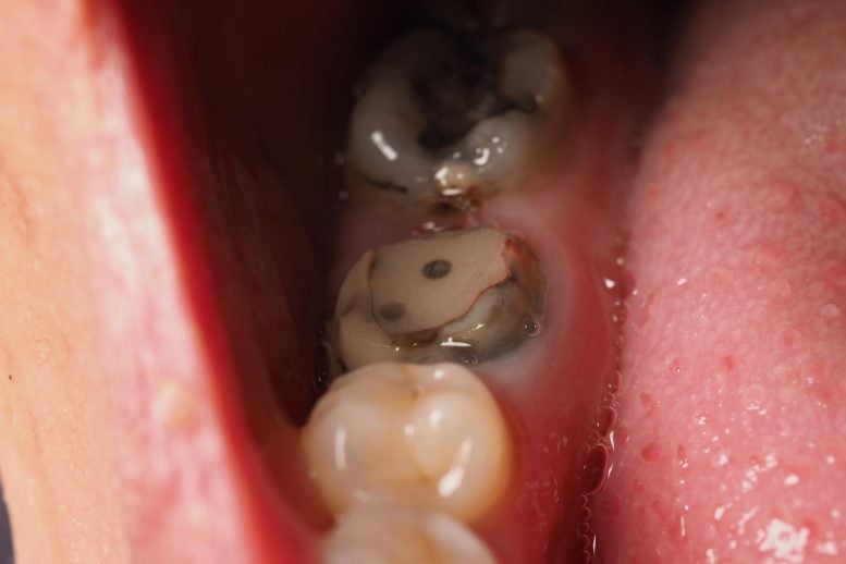 Decayed Tooth Root Canal Treatment Lower Molar