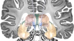 Deep Brain Stimulation for Alzheimer’s Disease