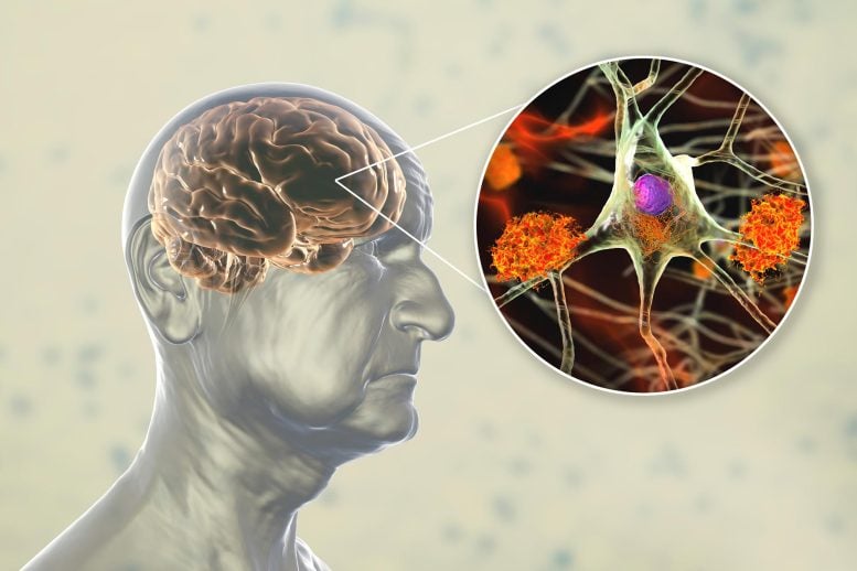 Dementia Alzheimer's Disease Brain Neuron Inset