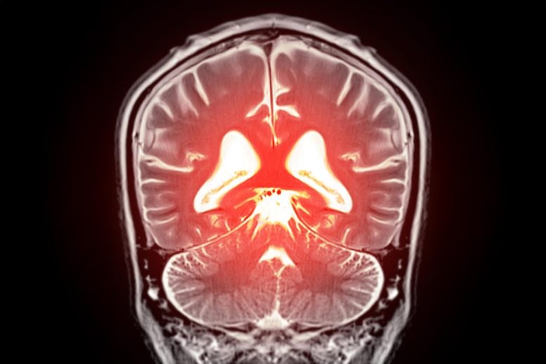 A Missing Brain Molecule May Be Driving Vascular Dementia