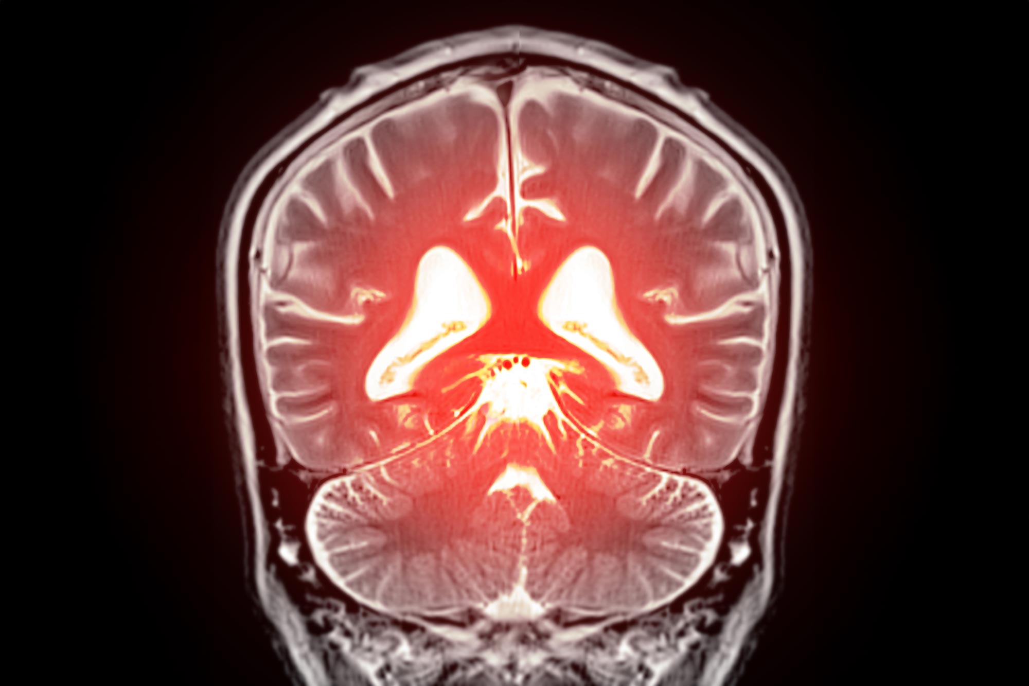 A Missing Brain Molecule May Be Driving Vascular Dementia