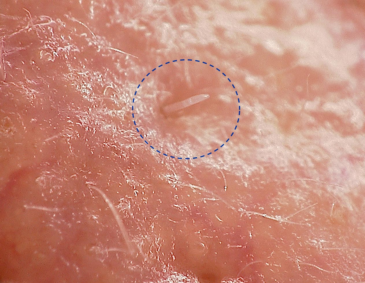 Demodex folliculorum leaks into the skin