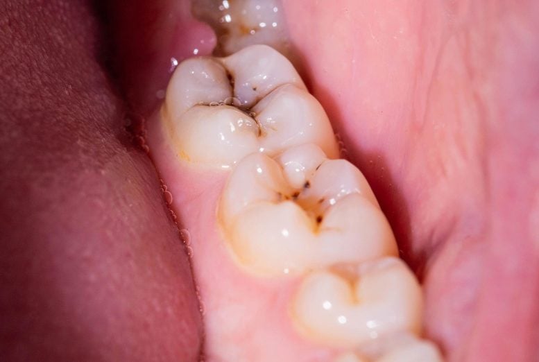 Dental Cavities Chewing Teeth