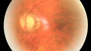 Diabetic Eetinopathy Eye Disease