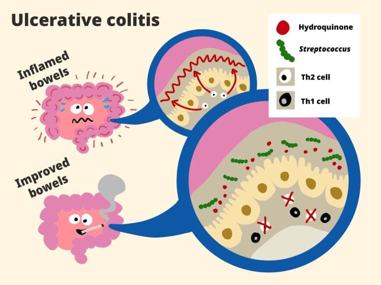 Diagram of Th1 and Th2 Cell Activity in Ulcerative Colitis