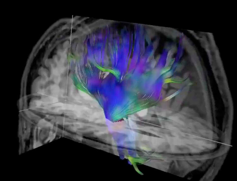 Diffusion Tensor Imaging of the Brain