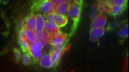 Discovery Reveals Important Clues to Cancer Metastasis