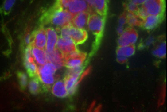 Discovery Reveals Important Clues to Cancer Metastasis