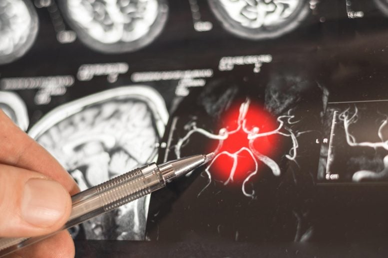 Doctor Examines Brain Scan Disease Treatment