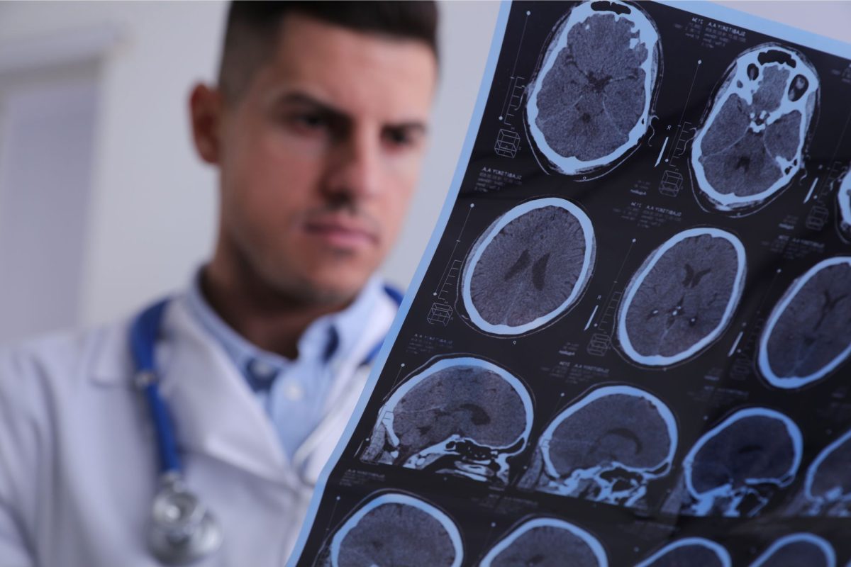 Scientists find a way to potentially repair myelin sheath nerve damage in MS