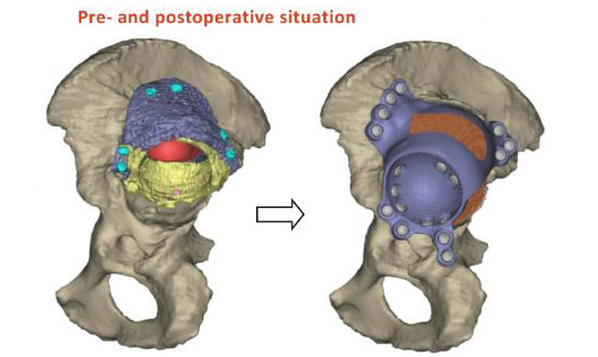 Doctors Complete Hip Surgery with 3D Printed Implant and Bone Stem Cell Graft