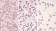 Doctors Crack the Code of Anemia