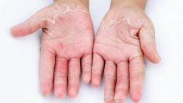 Dry Peeling Hands