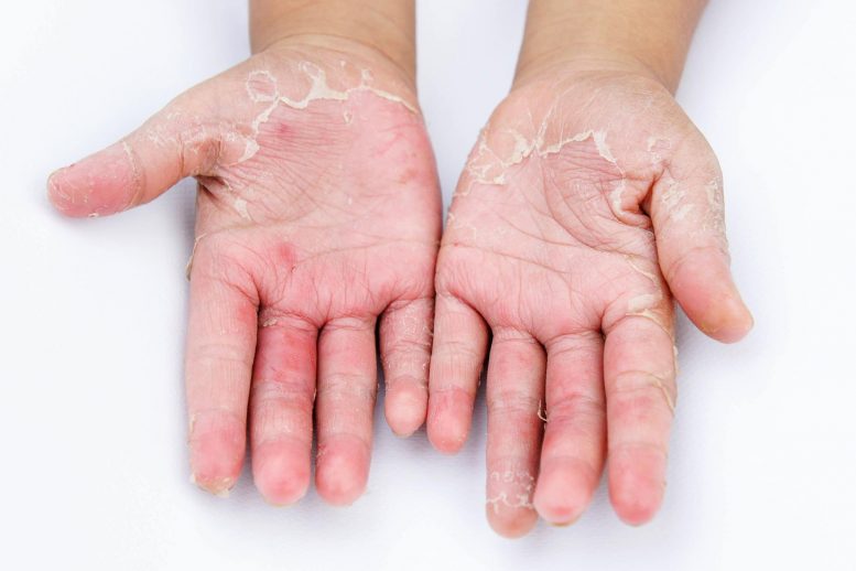 Dry Peeling Hands