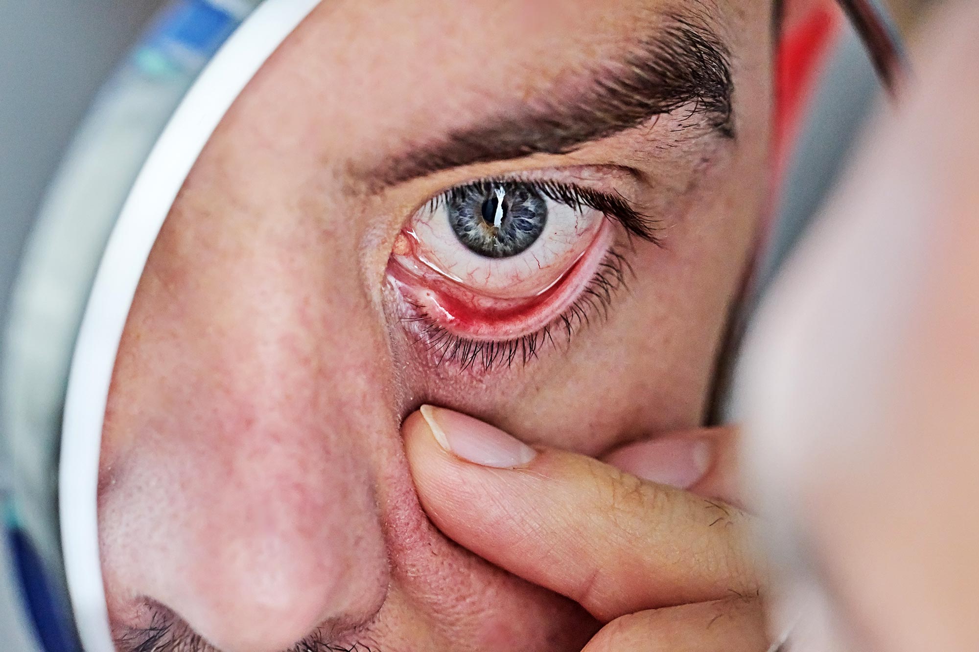 Dry Red Irritated Eyes