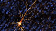 Dying Neuron Damaged by Tau Protein