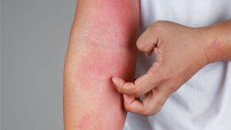 Eczema Arm Allergy Skin Concept