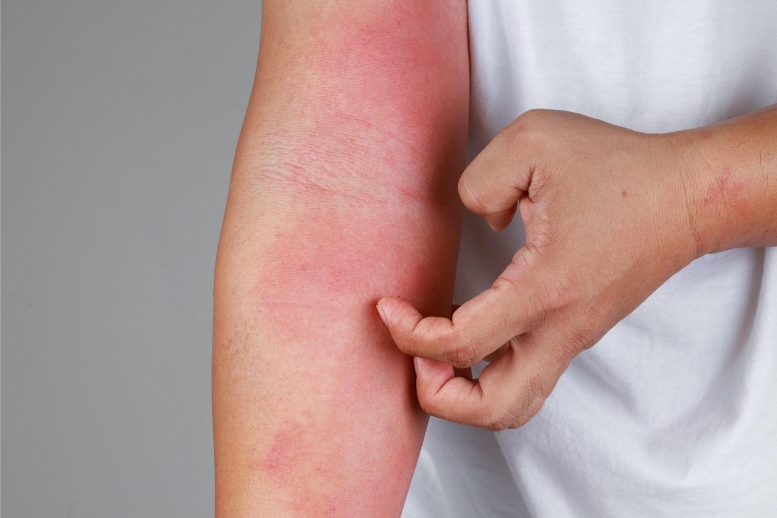 Eczema Arm Allergy Skin Concept