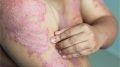 Eczema Dermatitis Skin