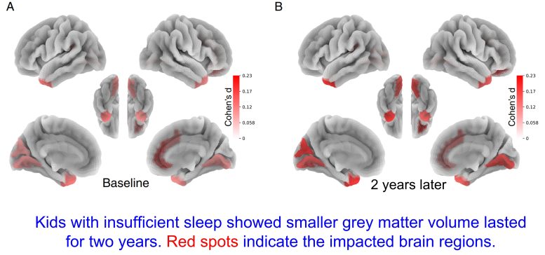Effects of Insufficient Sleep on Brain Structural Measurements