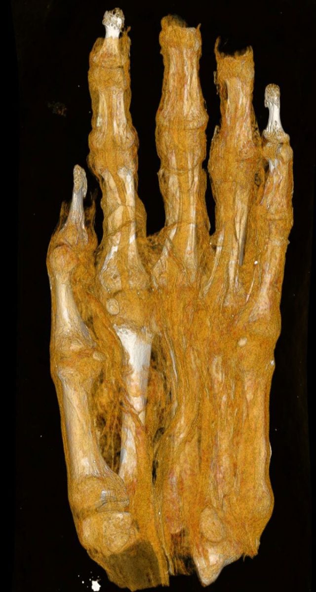 Egyptian Mummy Hand Examined at Semmelweis University