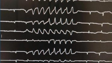 Electrocardiographic Chloroquine Therapy Coronavirus