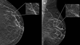 Example Mammogram Assigned a False-Positive Case Score