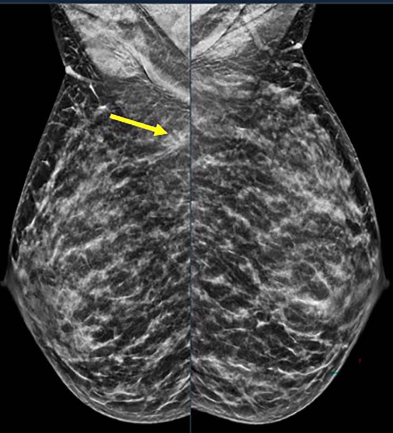 Extremely Dense Breast Tissue Is Noted on Mammography