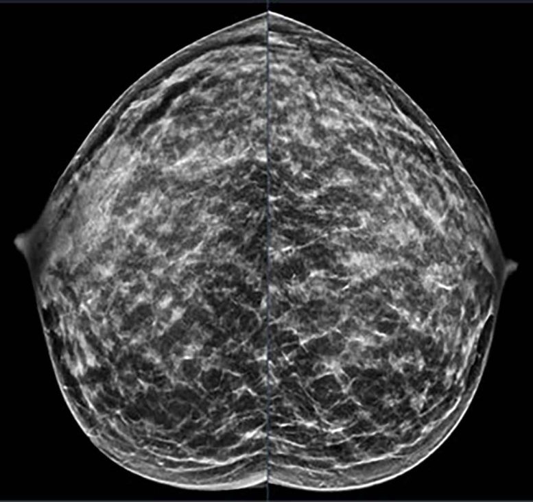 Extremely Dense Breast Tissue Mammography