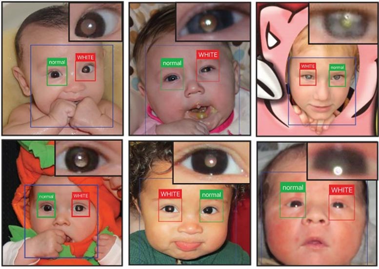 Eye Disease Detector App
