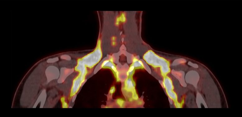 FDG PET CT Scan Showing Active Brown Fat